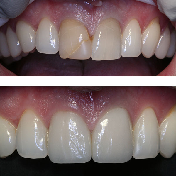 whitening gel for bonded teeth